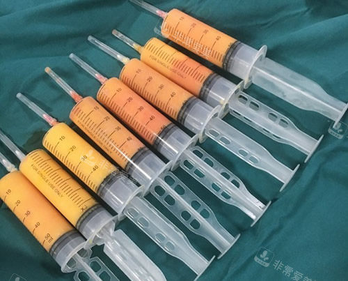 吸脂手术抽出来的脂肪照片