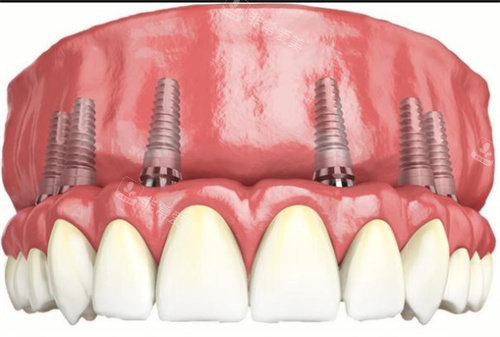 全口种植牙动画示意图