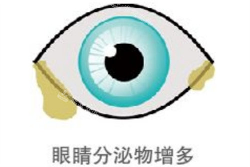 眼睛分泌物增多示意图