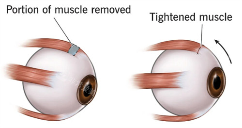 斜视眼睛肌肉和正常眼睛肌肉不同
