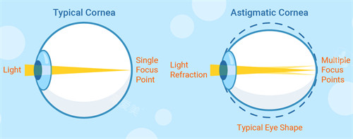 正常眼睛和散光眼睛成像不同