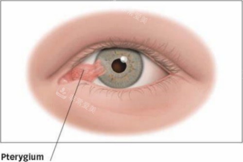 翼状胬肉眼睛示意图