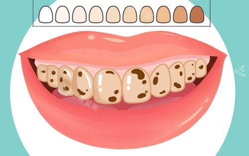 牙齿比色示意图