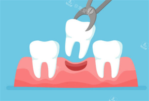 牙齿拔牙示意图