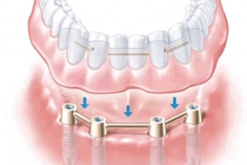 all-on-4种植卡通展示图