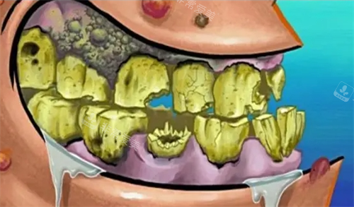 口腔烂牙齿动画展示