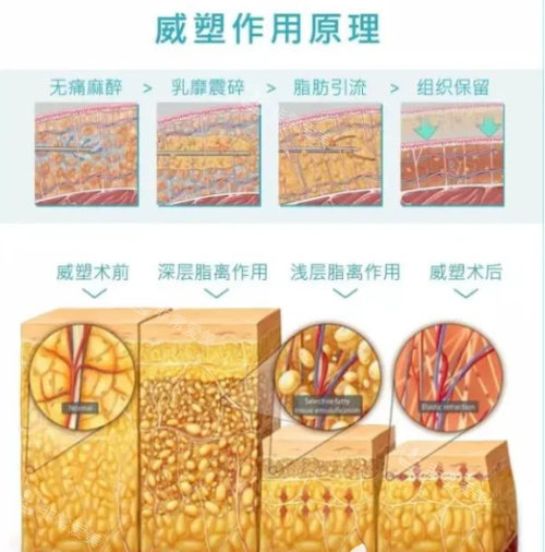 韩国吸脂技术怎么样?认真说和国内真不一样,吸脂后的平整度/修复时间/价格都有差异!