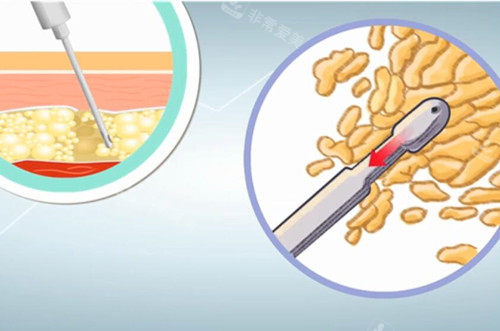 吸脂微觀示意圖 吸脂微觀示意圖