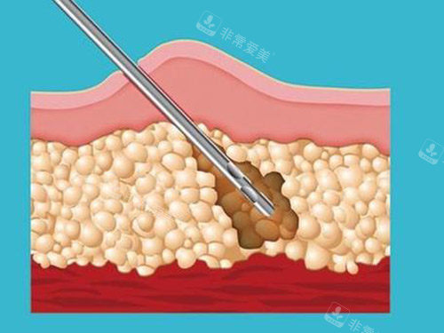 吸脂针图片 吸脂针图片