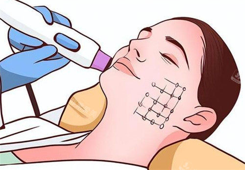 热玛吉动画图 热玛吉动画图