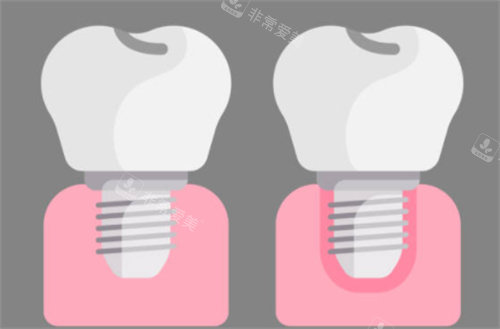 种植牙前后对比图