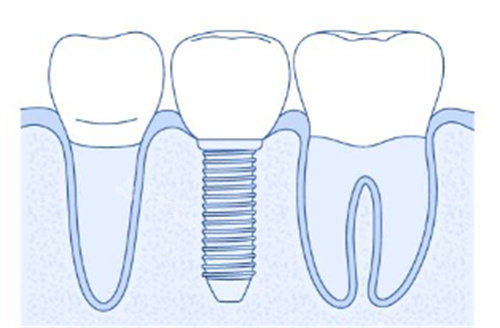 简单种植牙背景图