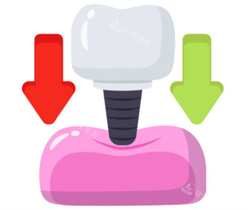 种植牙的用力示意图