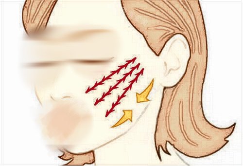 拉皮手術(shù)面部提拉示意圖.jpg 拉皮手術(shù)面部提拉示意圖.jpg