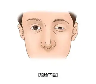 眼睑下垂