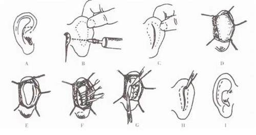 耳朵矯正手術(shù)