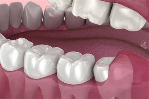 牙龈包裹住智齿