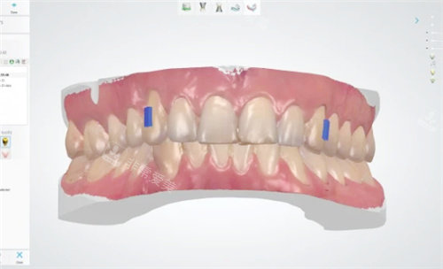 牙齿矫正方案设计中