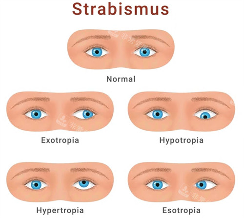 斜视手术不同症状
