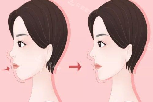 凸嘴改善前后對(duì)比圖