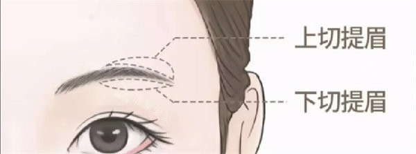 提眉术