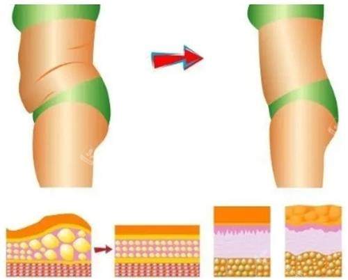 我的赴韩吸脂实录分享：从“梨形身材”到“衣架子”的蜕变，这些坑你一定要避开！