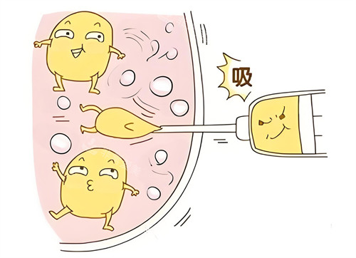 吸脂 吸脂