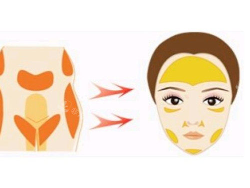 脸部脂肪填充图片