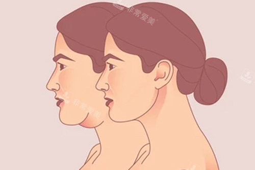 颈部拉皮变成天鹅颈 颈部拉皮变成天鹅颈