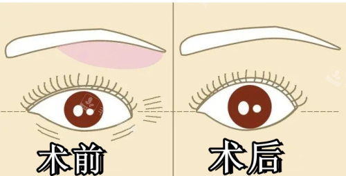 提眉术前术后对比图