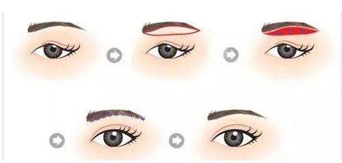 提眉手术步骤示意图