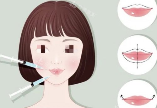 丰唇注射前后示意图