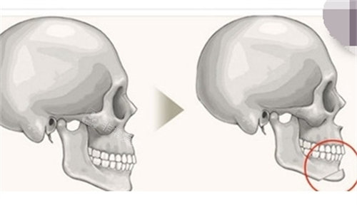下巴截骨骨骼剖面图