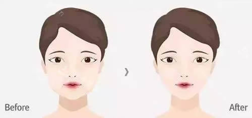 面部輪廓整形前后對(duì)比圖 面部輪廓整形前后對(duì)比圖