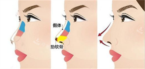 鼻綜合術(shù)后對比 鼻綜合術(shù)后對比