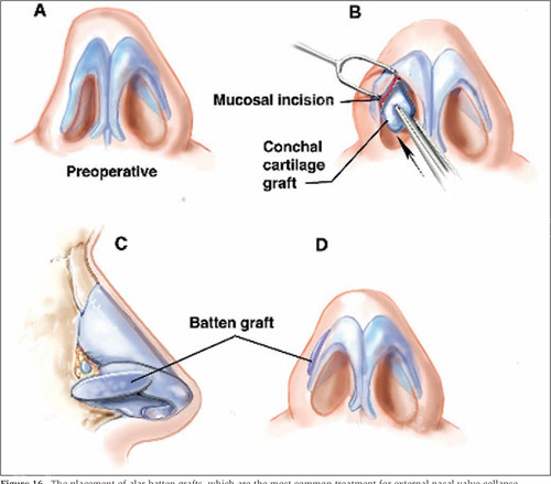 修复畸形的鼻子