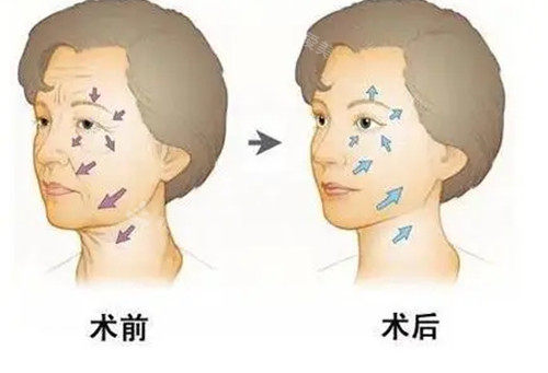 面部抗衰前后對(duì)比卡通示意圖 面部抗衰前后對(duì)比卡通示意圖