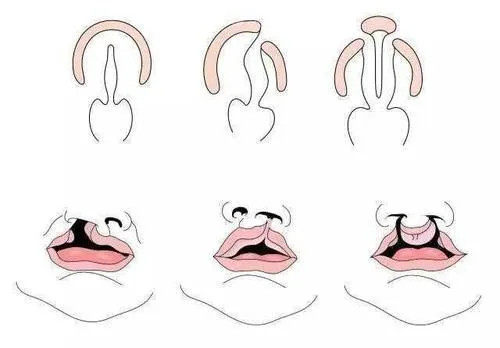唇腭裂外形卡通示意圖 唇腭裂外形卡通示意圖