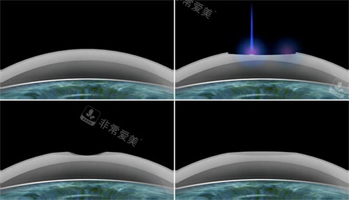 smart激光近视手术过程