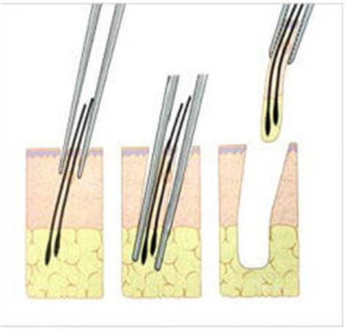 提取毛囊動畫圖 提取毛囊動畫圖