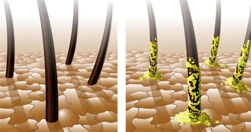 健康毛囊與脂溢性毛囊的區(qū)別對比圖 健康毛囊與脂溢性毛囊的區(qū)別對比圖