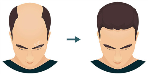 植發(fā)前后對比圖 植發(fā)前后對比圖