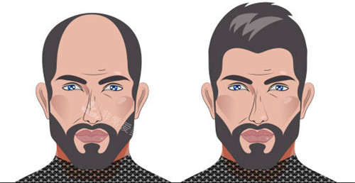 植發(fā)前后對比圖一覽 植發(fā)前后對比圖一覽