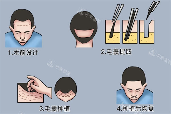 植發(fā)手術 植發(fā)手術