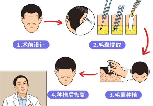 植發(fā)手術的流程操作圖 植發(fā)手術的流程操作圖