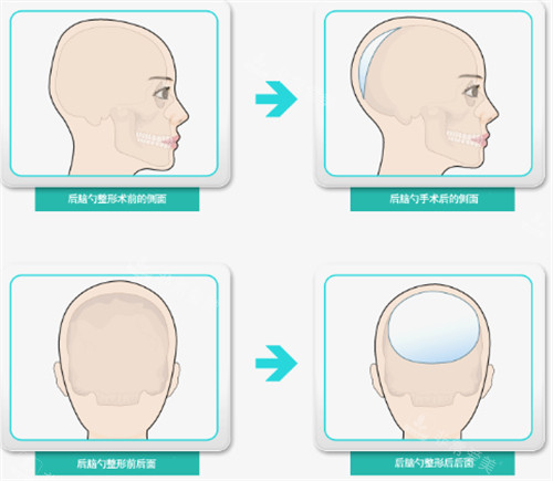 后腦勺填充過程 后腦勺填充過程