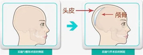 后腦勺手術(shù) 后腦勺手術(shù)