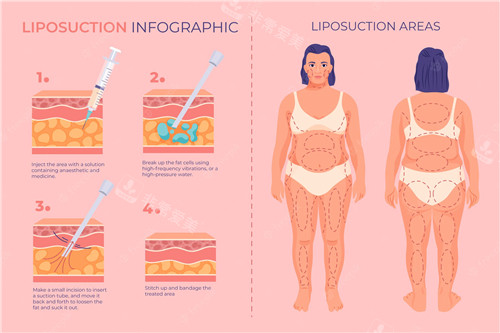 吸脂前后對(duì)比照 吸脂前后對(duì)比照