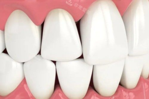 牙齿黑三角图片展示