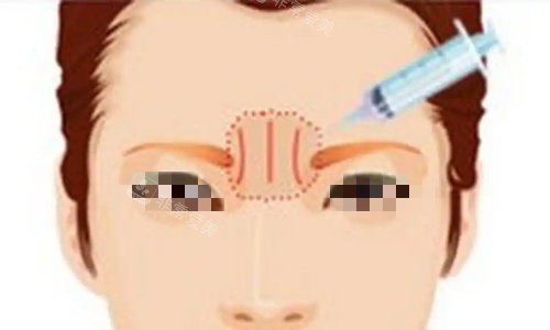 川字纹注射示意图